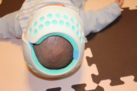 頭蓋矯正用ヘルメットの衛生維持にピュオロジェン・インターセプション